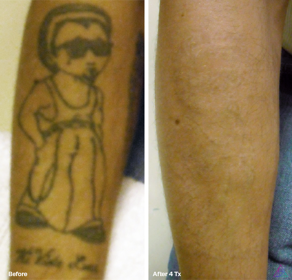 Before and after tattoo removal